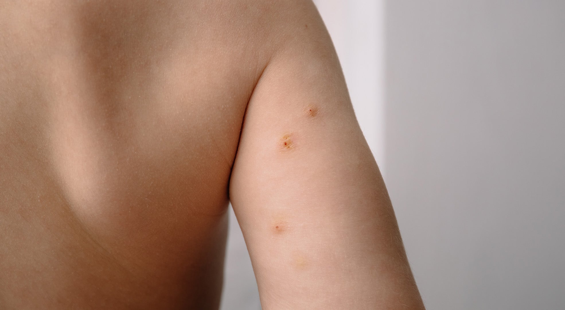 Dellwarzen erkennen, behandeln und vorbeugen: Ursachen, Symptome und effektive Lösungen