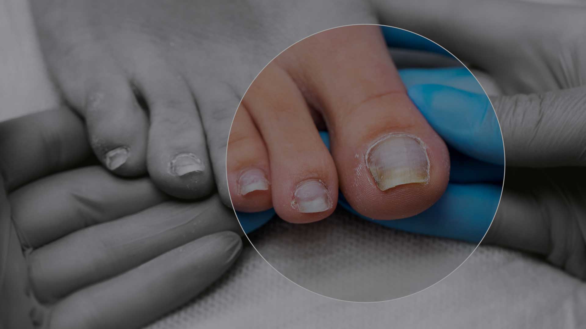 Wie erkennt man Nagelpilz? Alles, was Sie wissen müssen! – Evolsin-Medical