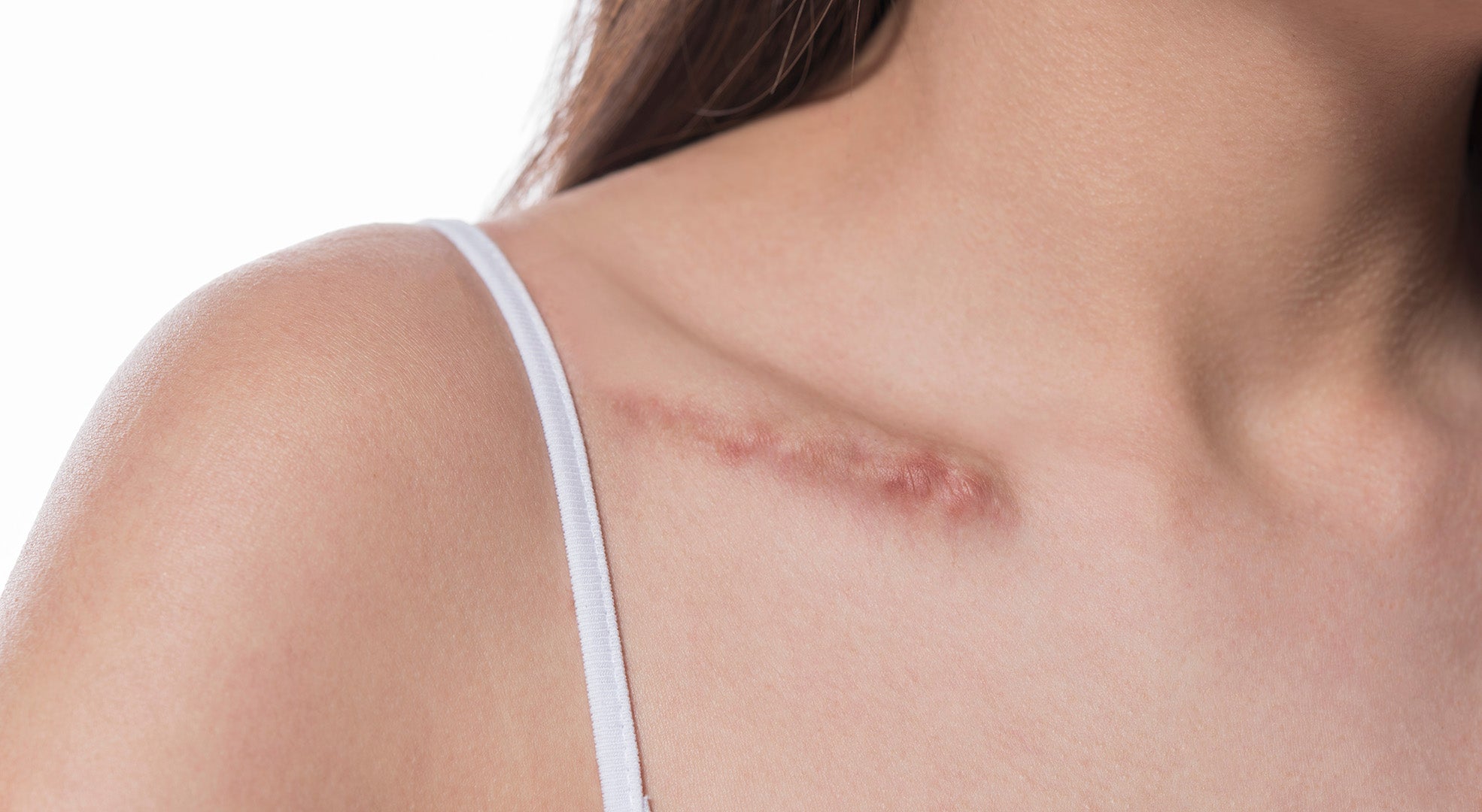 Narbenpflege richtig gemacht: So verbessern Sie das Hautbild effektiv