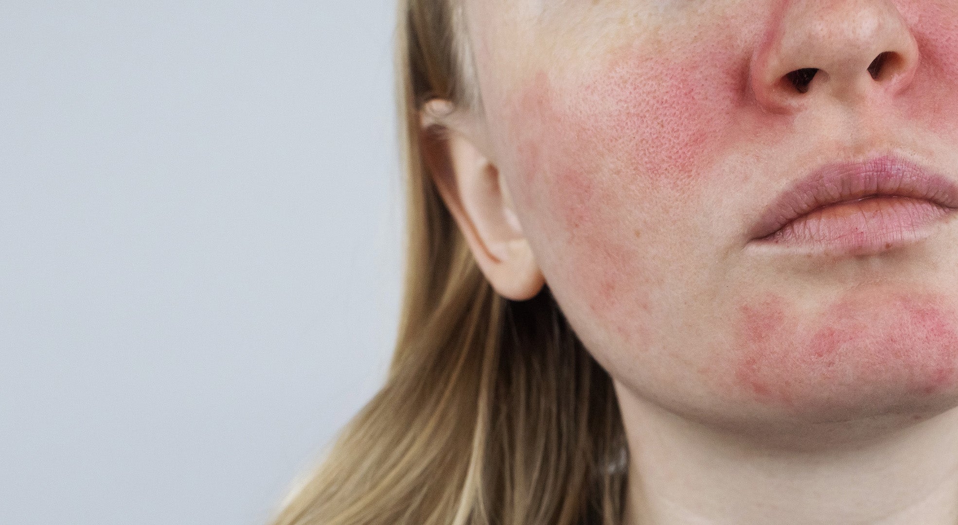 Neurodermitis Symptome, Ursachen, Behandlung und Trigger – was hilft bei atopischer Dermatitis?