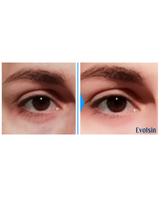 augen kur roll on