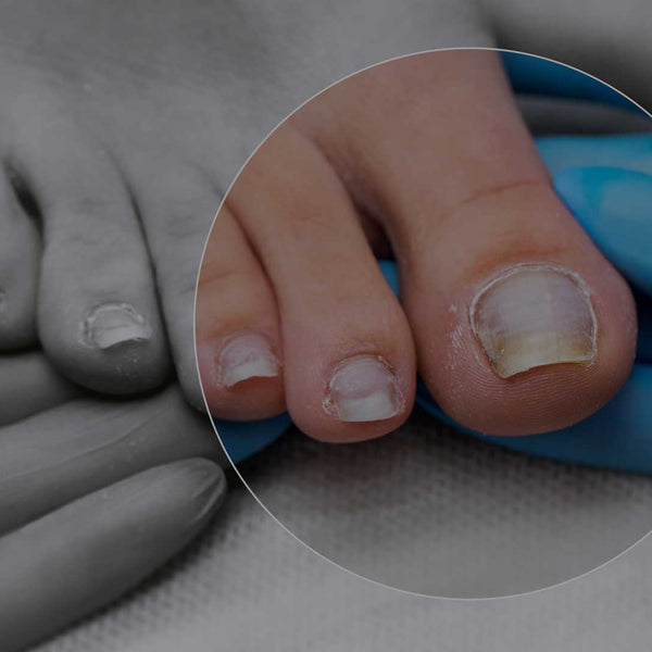 Wie erkennt man Nagelpilz? Alles, was Sie wissen mssen!  Evolsin-Medical