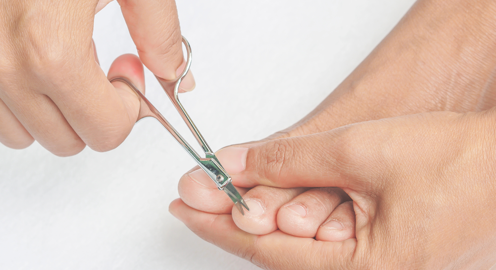 Nagelweicher Nutzung – effektive Hilfe bei eingewachsenem Zehennagel