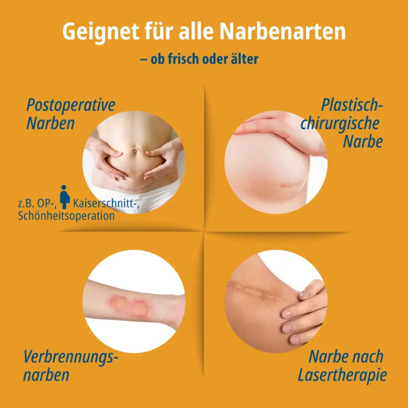 Evolsin Silikon-Narbenpflaster zur Behandlung alter und neuer Narben