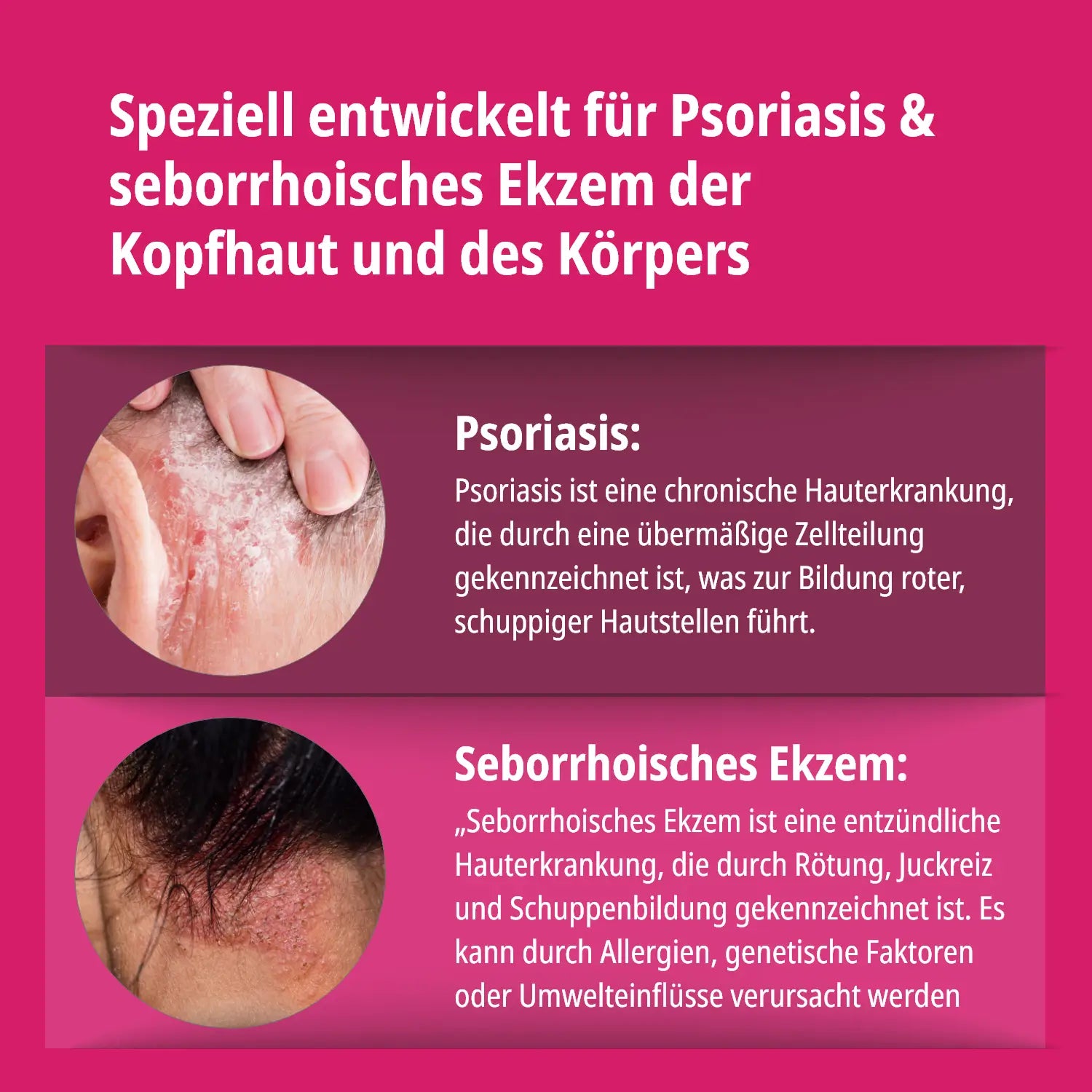 Psoriasis & Ekzem Shampoo 3er Pack