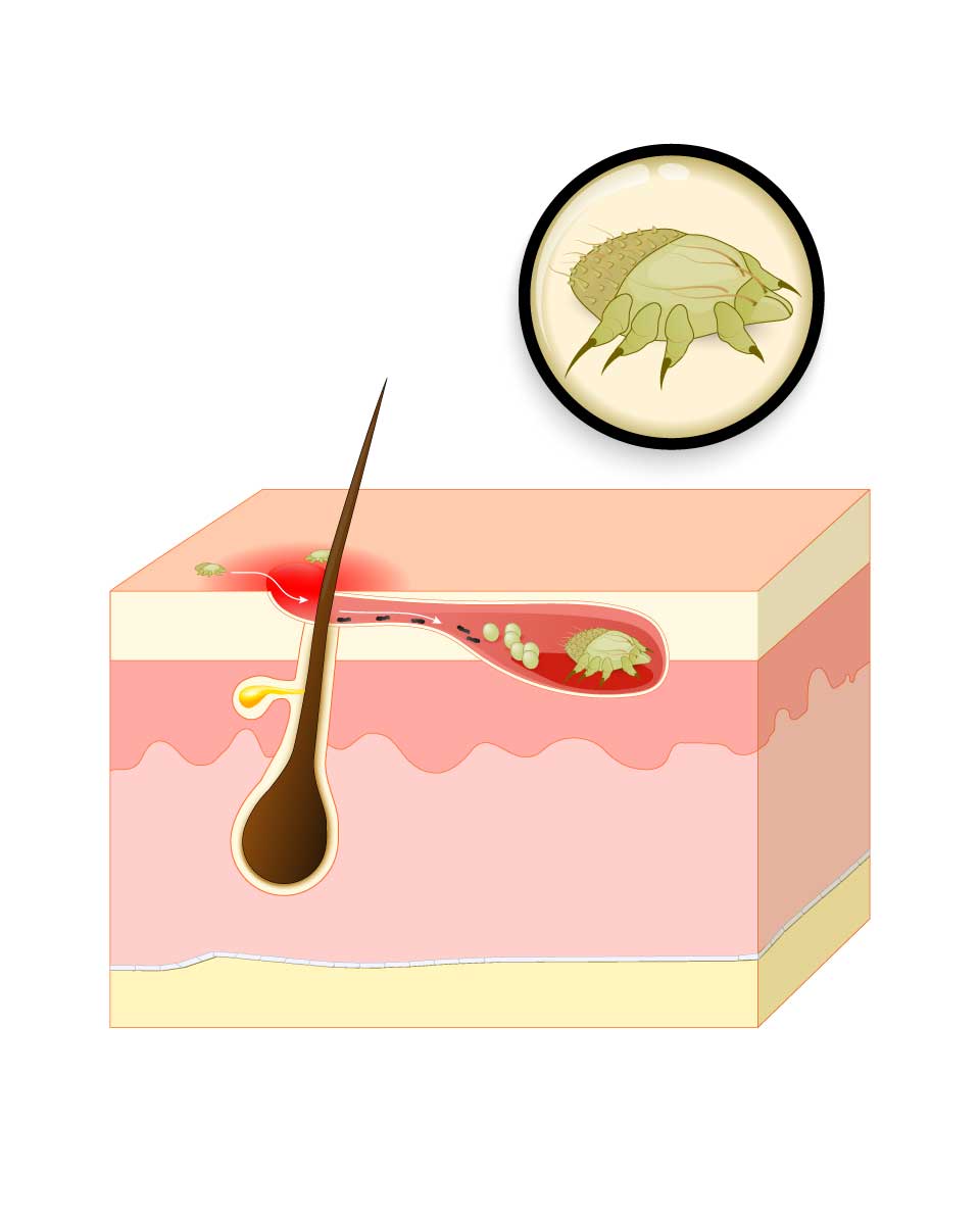 Krätze Ratgeber EvolsinMedical