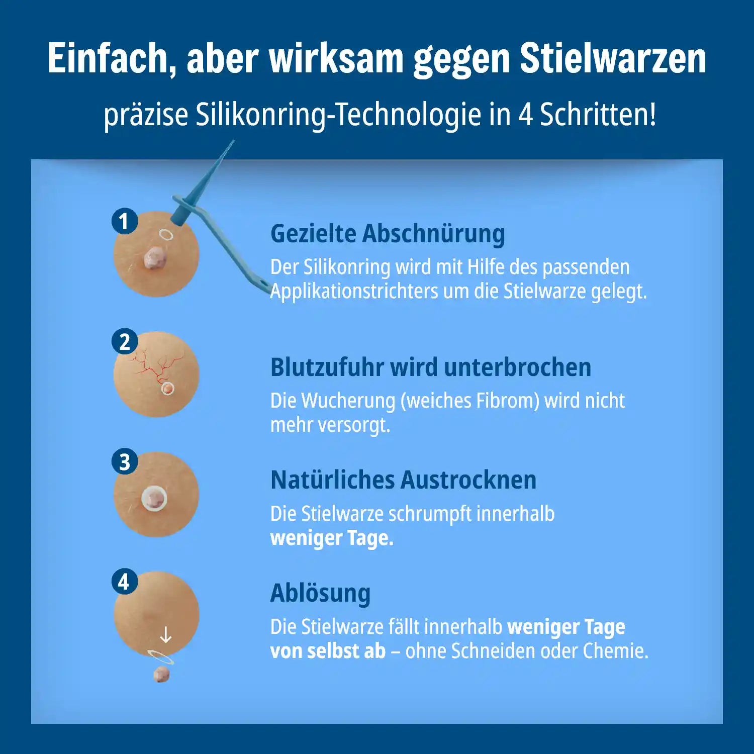 Anti Stielwarze