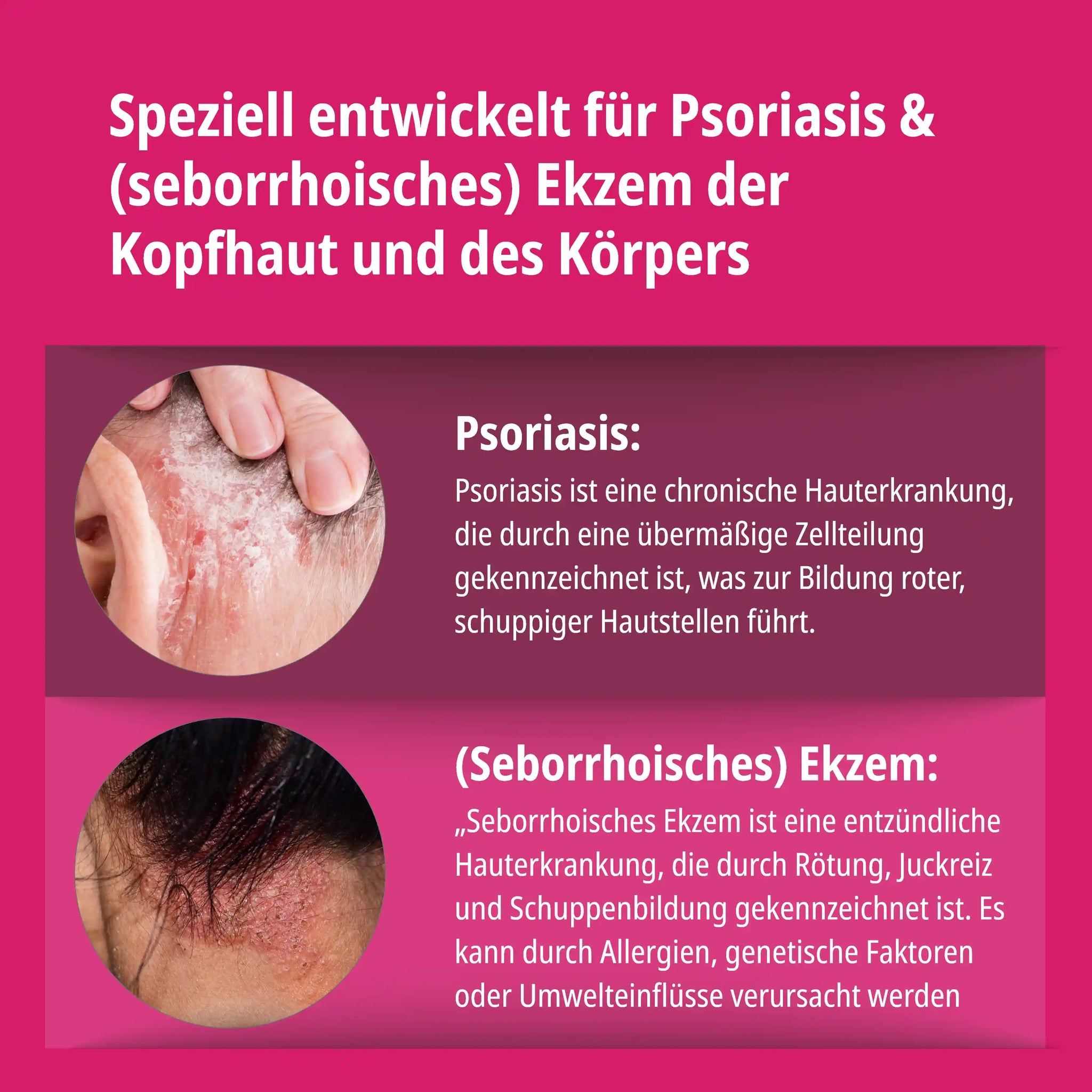 Psoriasis & Ekzem Shampoo für Kopfhaut & Körper