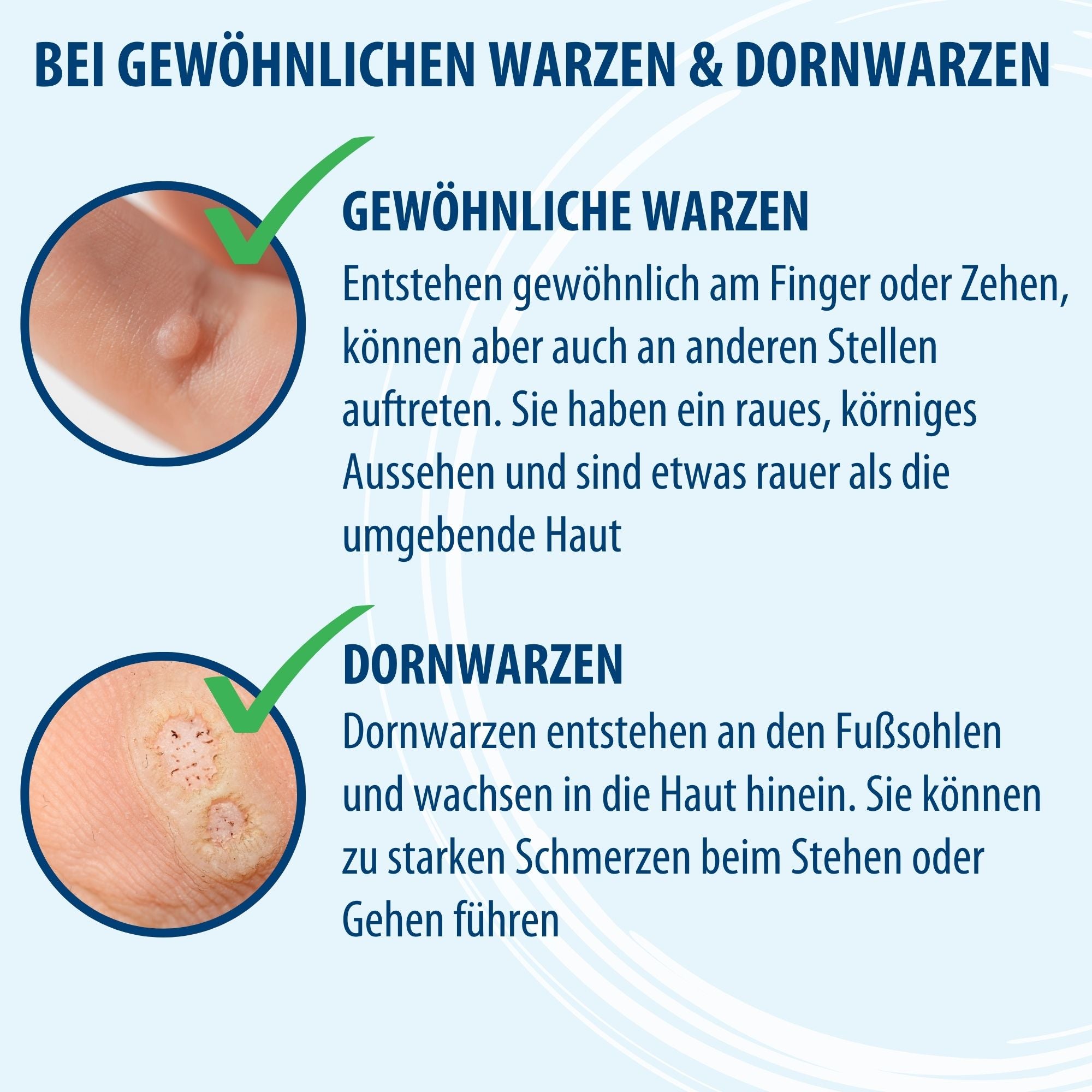 Wie Kann Man Eine Warze Entfernen
